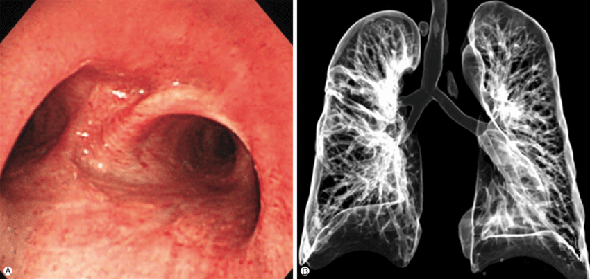 Virtual Bronchoscopy