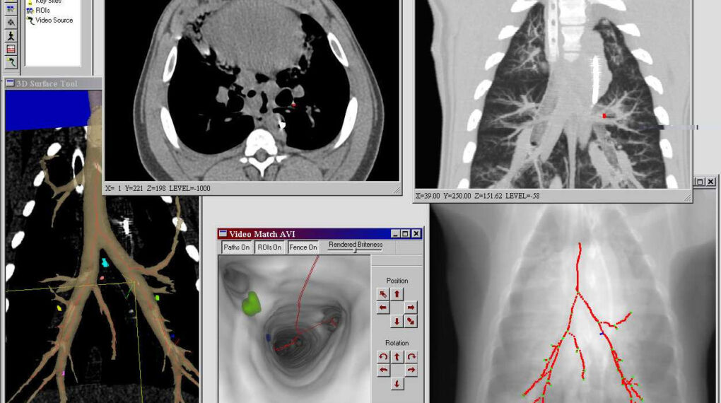 Virtual Bronchoscopy